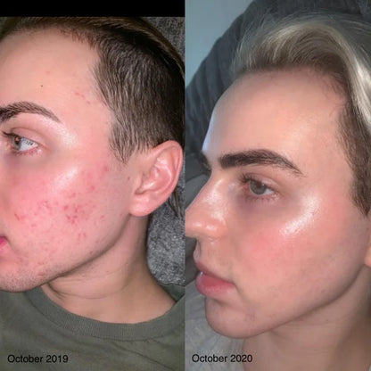 Sorlest LED Therapy Acne Mask™
