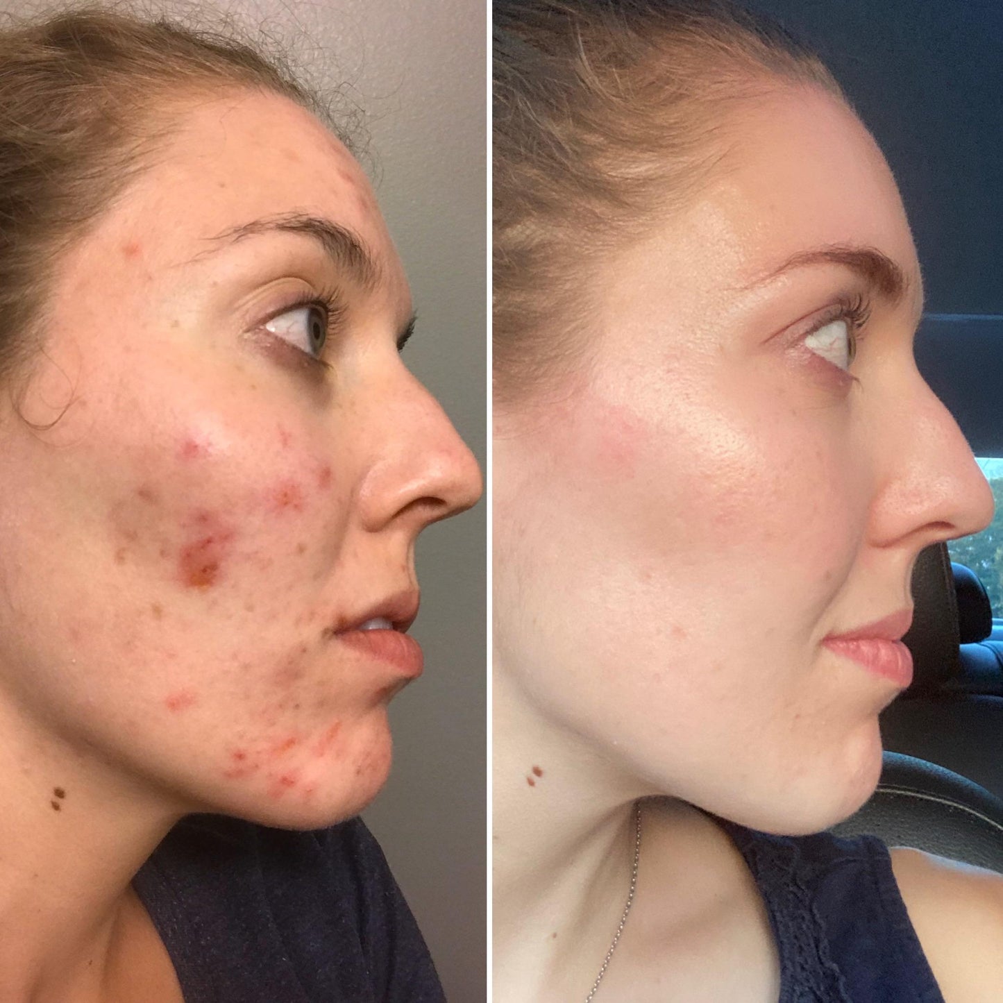 Sorlest LED Therapy Acne Mask™