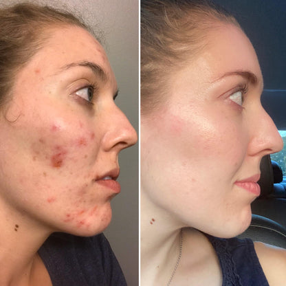 Sorlest LED Therapy Acne Mask™